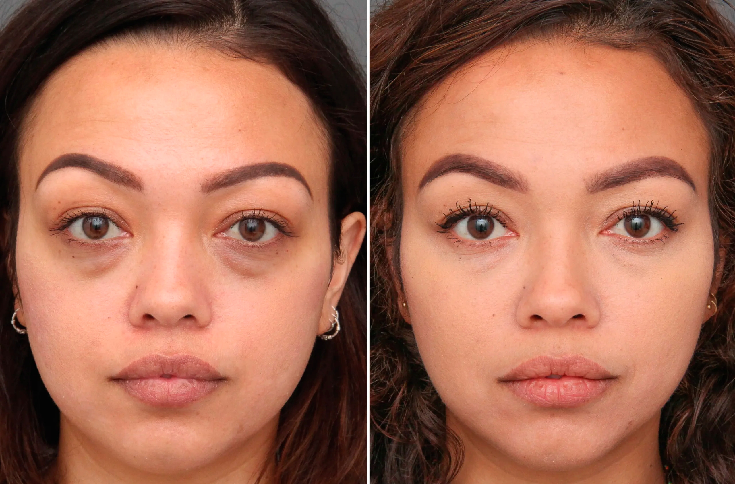 Antes e depois do tratamento - redução da aparência de cansaço