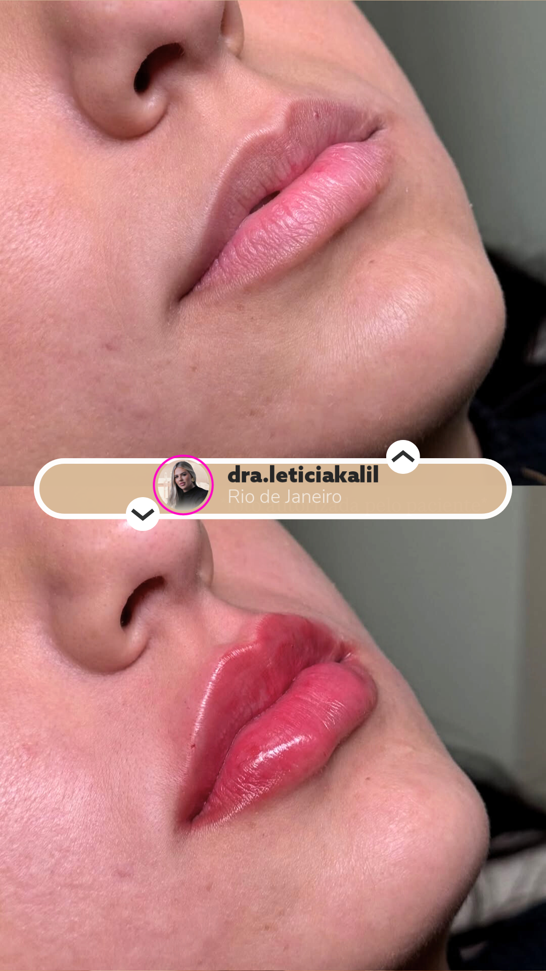 Antes e depois - Preenchimento Labial
