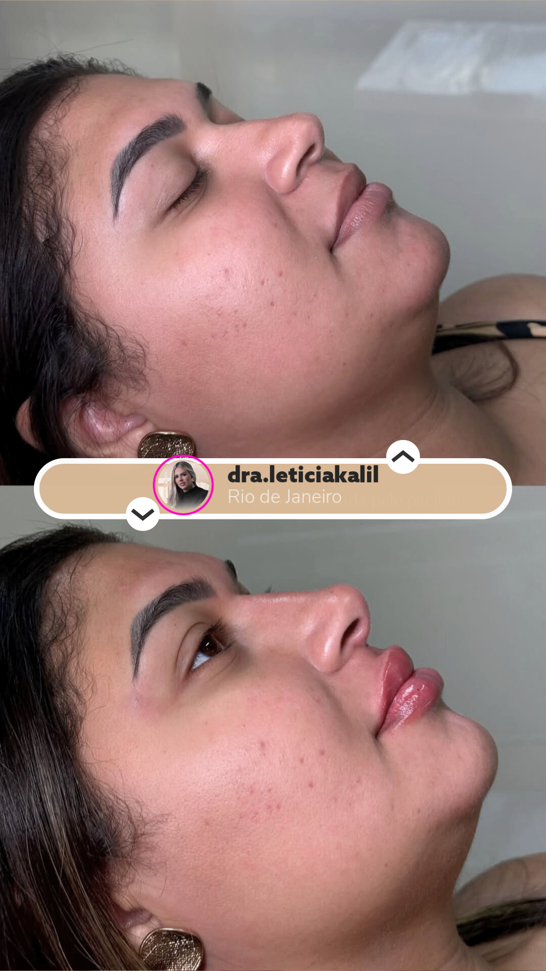 Antes e depois - Harmonização Labial